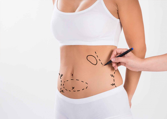 liposuction