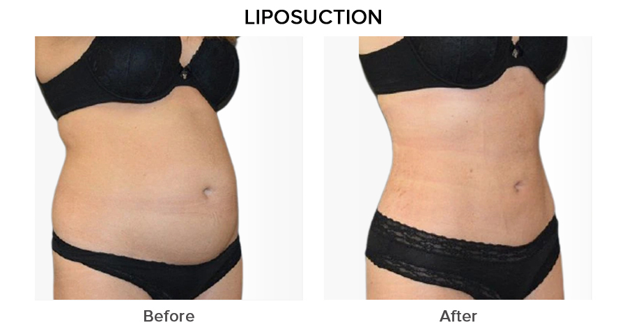 liposuction