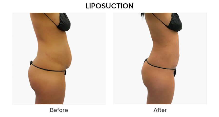 liposuction