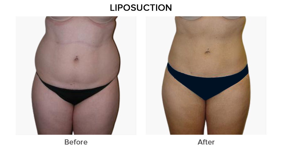 liposuction