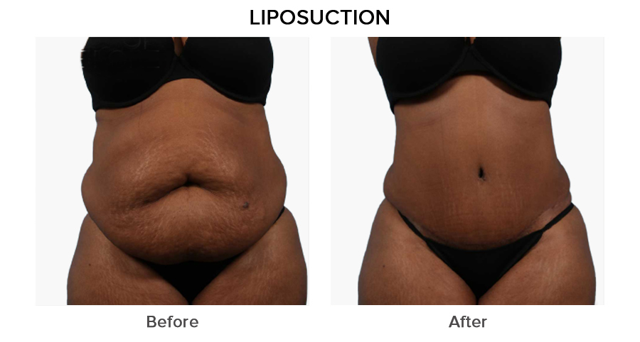 liposuction