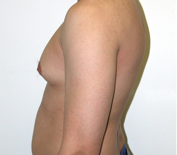 male breast reduction west delhi