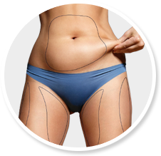 liposuction