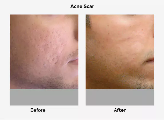 acne scar treatment before and after delhi