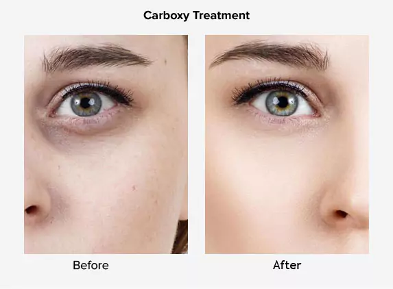 carboxy treatment before and after delhi