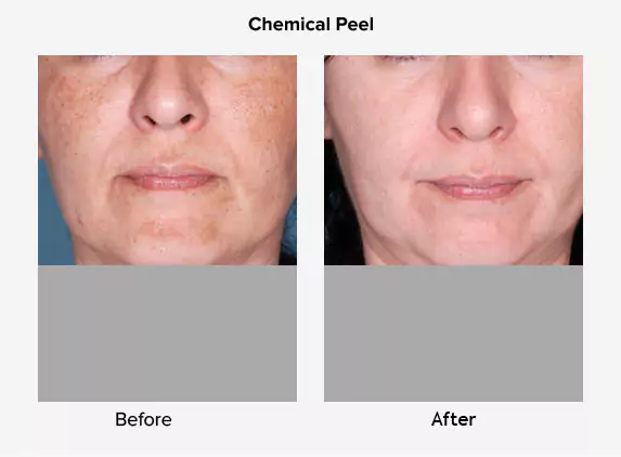 chemical peel before after delhi