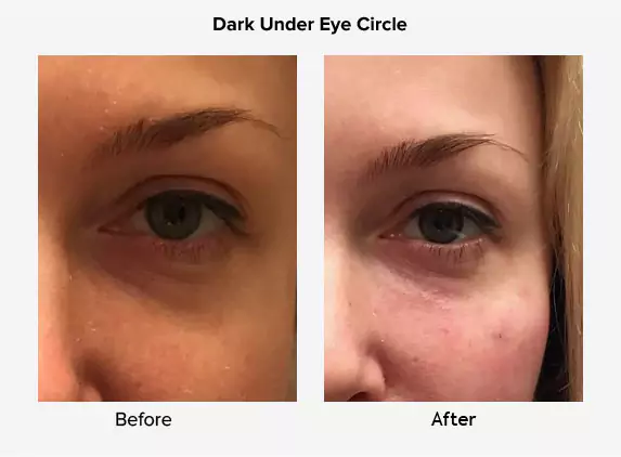 dark under eye circle treatment delhi