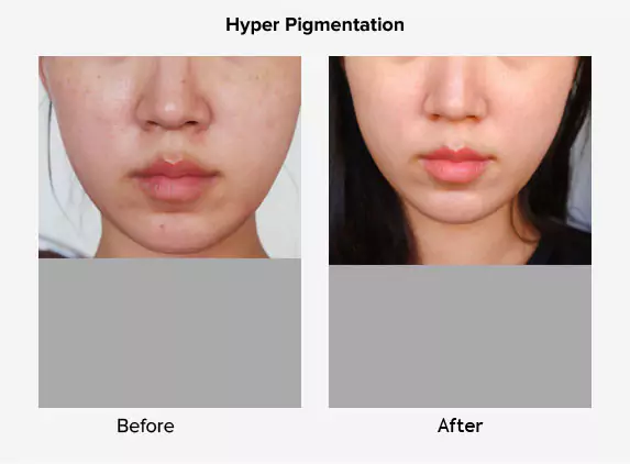 hyper pigmentation before after delhi