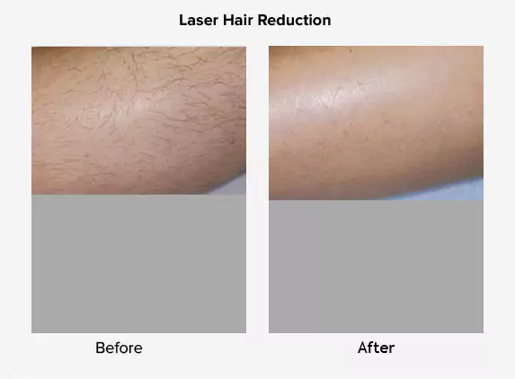 laser hair reduction before and after delhi