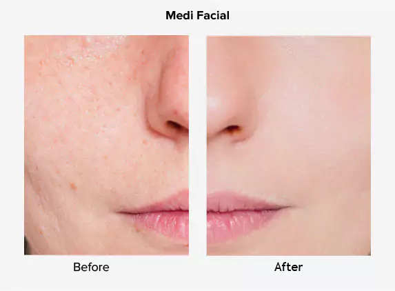 medi facial before and after delhi