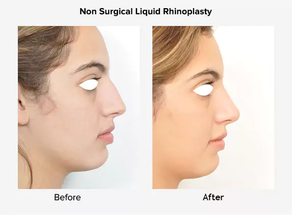 non surgical rhinoplasty before and after delhi