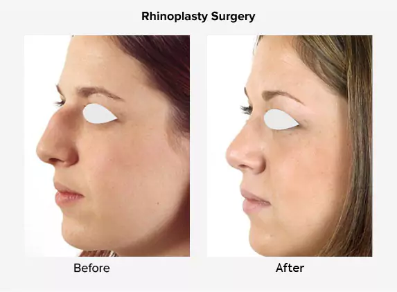 rhinoplasty surgery before after delhi