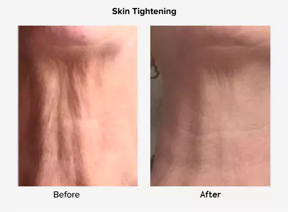 skin tightening before after delhi