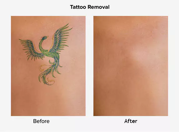 tatto removal before after delhi