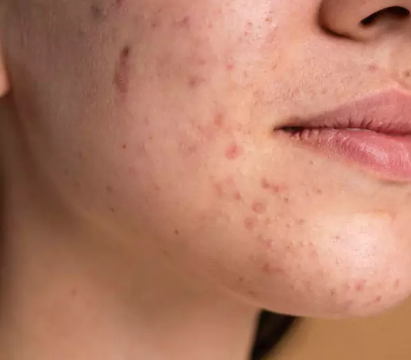 acne scar treatment new delhi